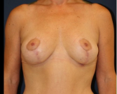 Feel Beautiful - Breast Lift 301 - After Photo